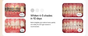 Read more about the article Opalescence Go 15% Prefilled Teeth Whitening Trays – The Easy Way to Brighten Your Smile at Home
