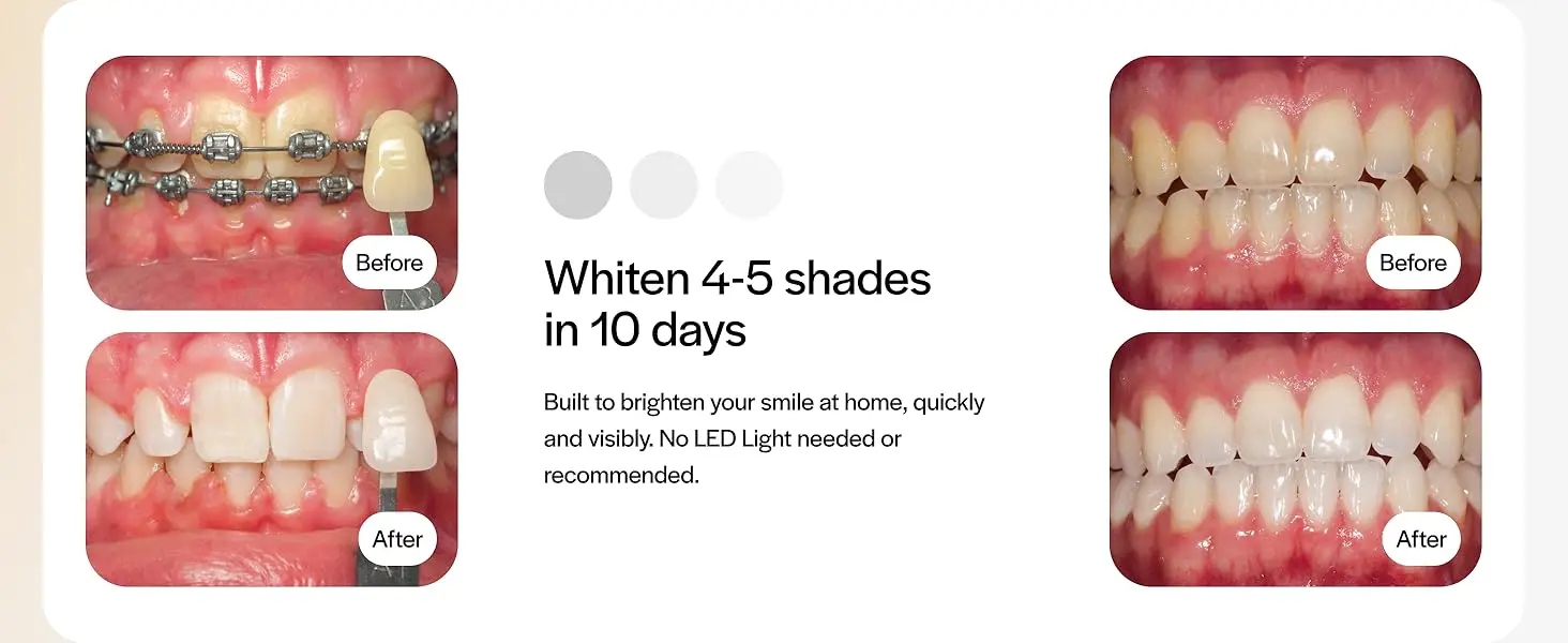Read more about the article Opalescence Go 15% Prefilled Teeth Whitening Trays – The Easy Way to Brighten Your Smile at Home